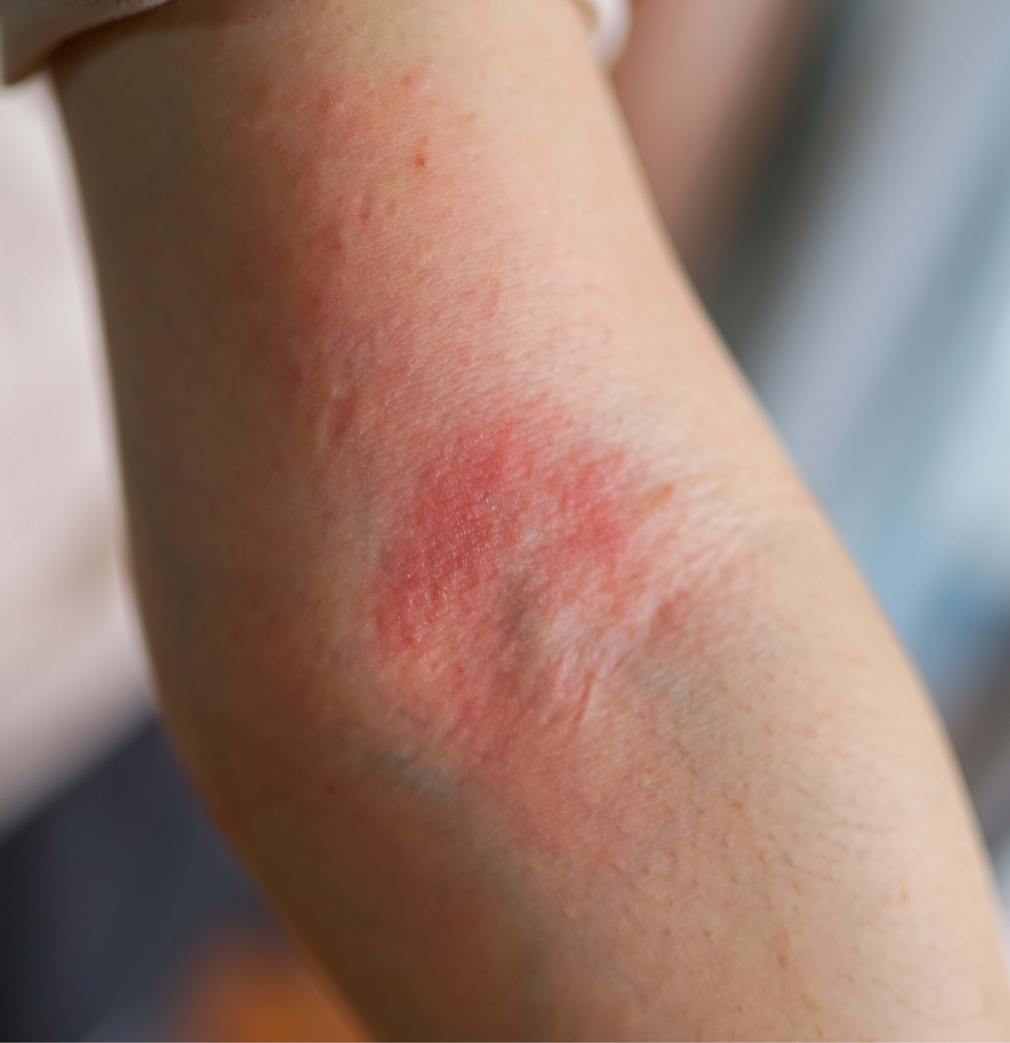 sintomi dell’eczema secco